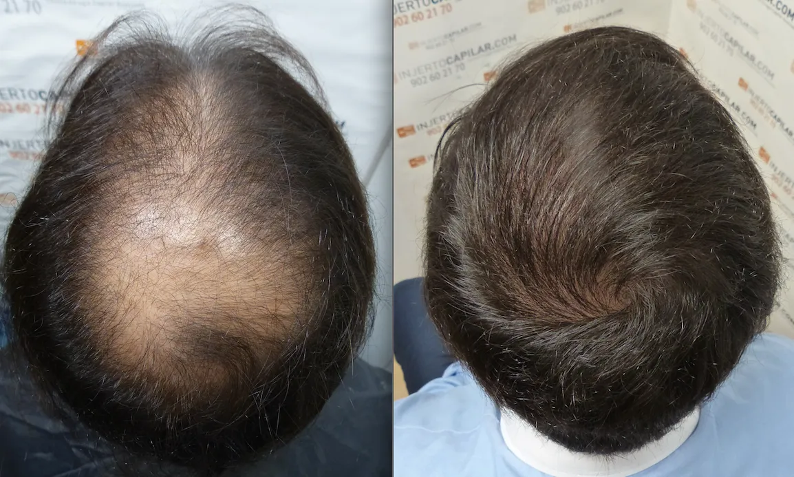 Antes y después de trasplante capilar masculino